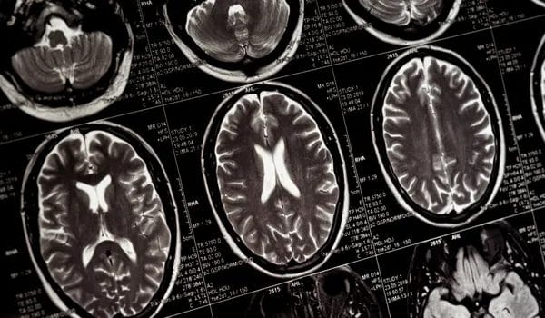 1. photo of bran scans to help emphasize the neurological impacts of pesticides